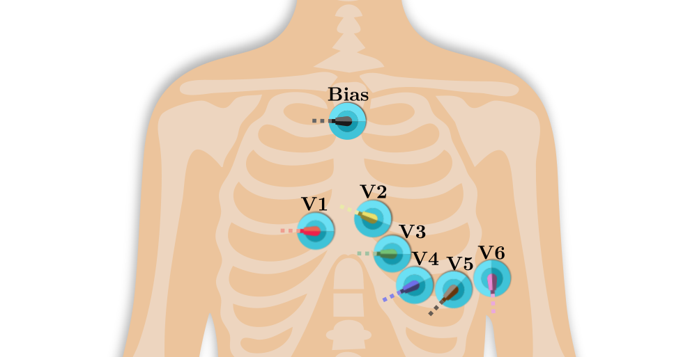 Diagram of the electrode placement for Electromyography.